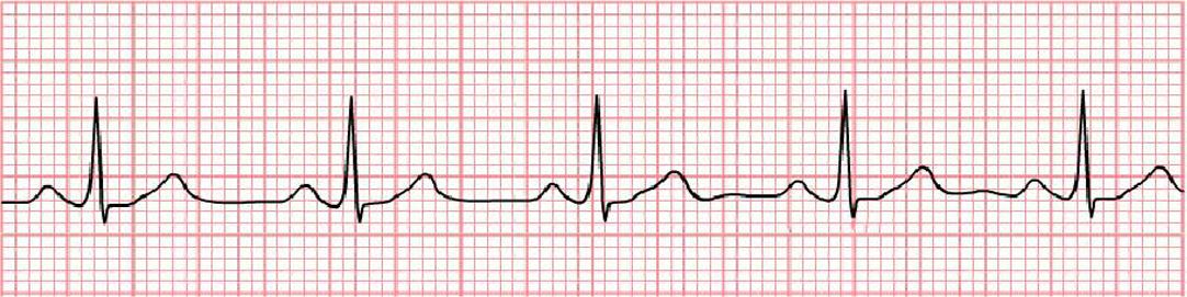 <p>WHAT IS THIS ECG READING?</p>