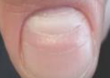 <p>Transverse depression of nail plate usually bilaterally</p>