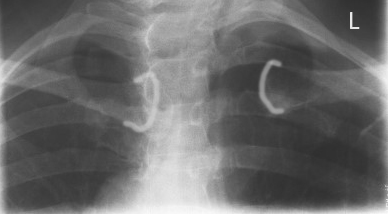 <p>AP SC joint - is there any rotation?</p>