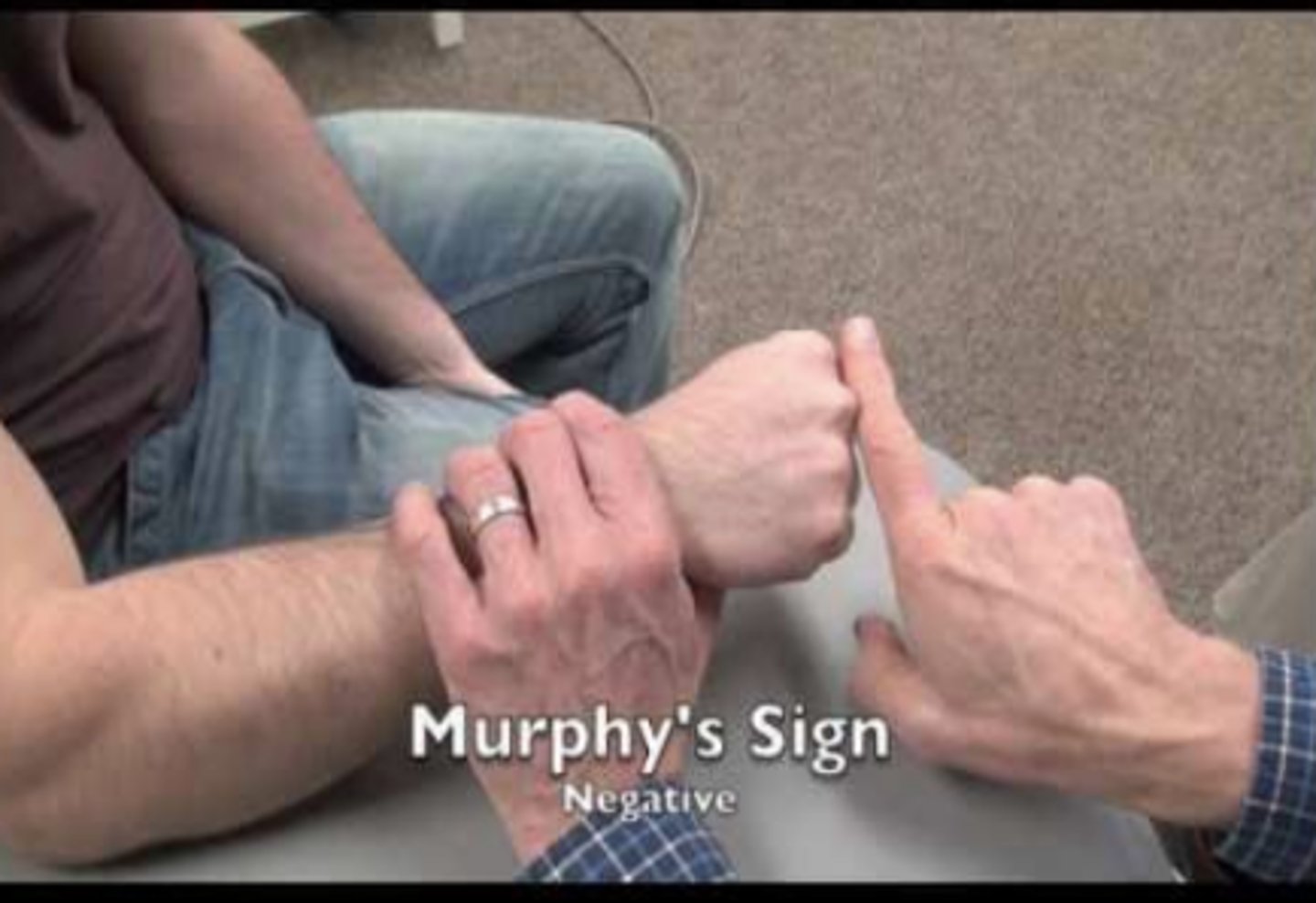<p>- lunate dislocate</p><p>- The patient is asked to make a fist. If the head of the third metacarpal is level with the second and fourth metacarpals, the sign is positive and indicative of a lunate dislocation. Normally, the third metacarpal would project beyond (or further distally) the second and fourth metacarpals.</p>