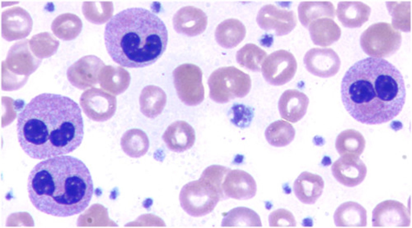 <p>Hyposegmented neutrophils (dumbell shape)</p>