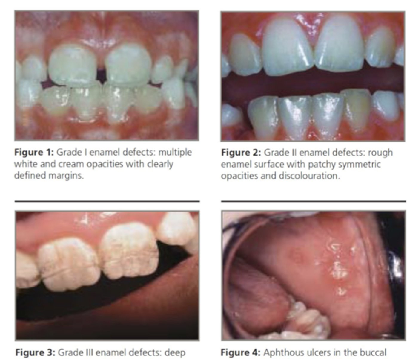 <p>-enamel defects --&gt; hypoplasia w/ discoloration &amp; banding</p><p>-aphthous ulcers</p>