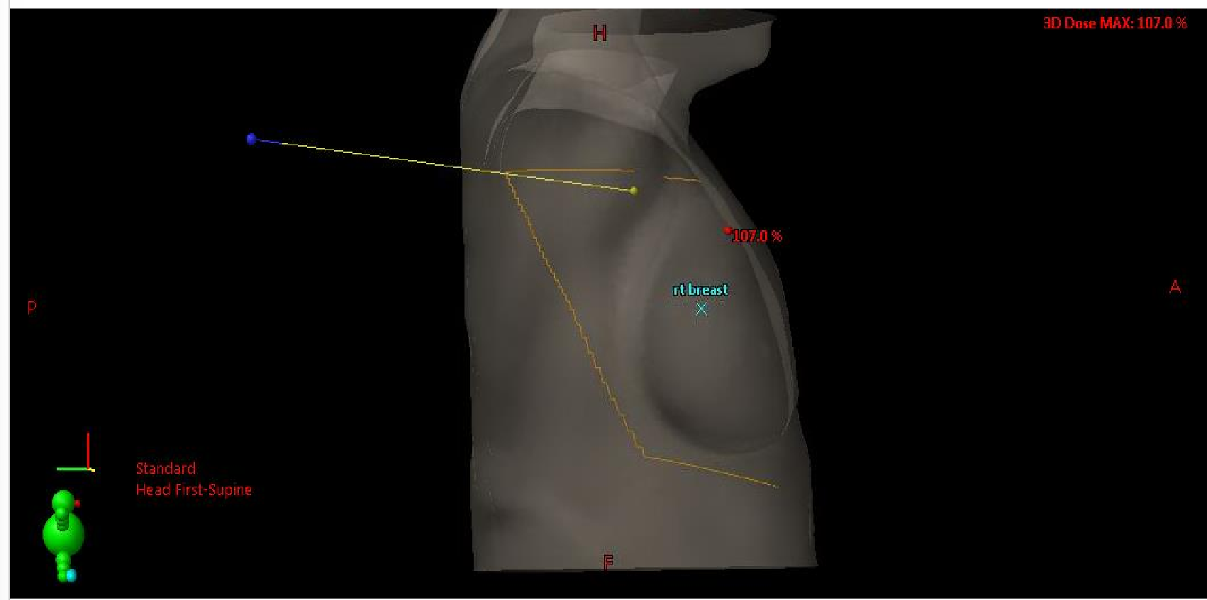 <p>patient has larger breast, so we must check the lateral skin rendering to ensure that the breast is following accurately</p>