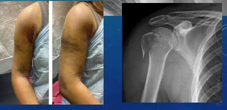<p><strong>Proximal Humerus Fracture: S/S and Diagnosis</strong></p><p>-S/S: </p><ul><li><p>____, swelling, __________</p></li><li><p>Arm _________ against body </p></li><li><p>_______ artery and nerve may be injured, so be sure to check the pt’s neurovascular status distal to the injury </p></li></ul><p>-Diagnosis:</p><ul><li><p>Xray (AP, axillary, scapular Y views) → ______ classification</p></li></ul><p></p>