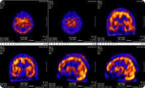 <p>SPECT: <span>a nuclear medicine imaging technique that creates detailed, 3D images of organs, tissues, and bones by detecting the gamma rays emitted by radioactive tracers injected into the body</span></p><p>Benefits: </p><ul><li><p>Combines function and structure so improved localisation </p></li></ul><p></p>