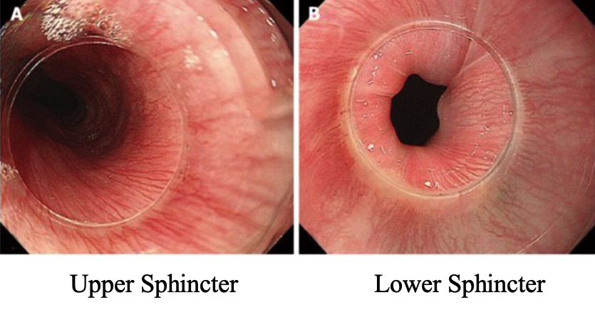 <ul><li><p>Upper sphincter (pharyngoesophageal): normally closed to prevent air entering the esophagus</p></li><li><p>Lower sphincter (gastroesophageal): normally closed to prevent acid reflux from the stomach</p></li></ul><p></p>