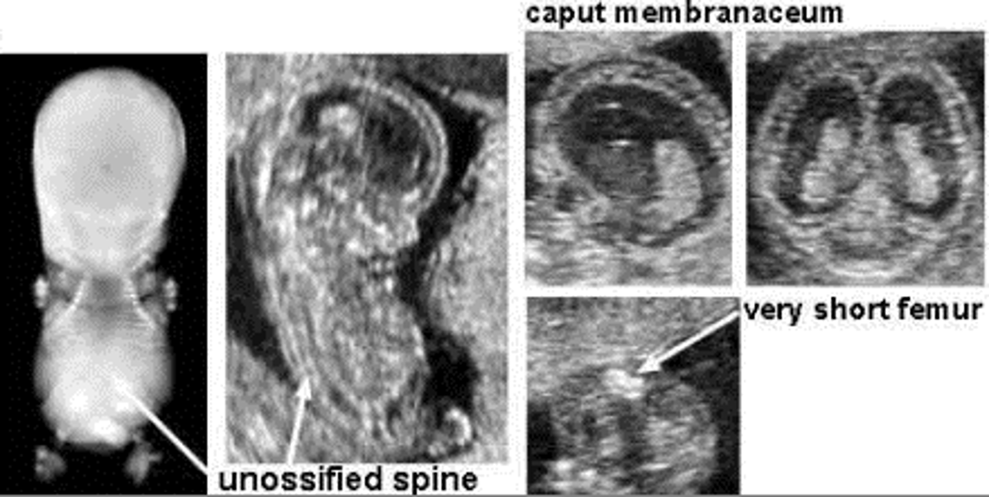 <p>A lethal condition due to failure to produce cartilage, resulting in short limbs and small chest, lethal due to pulmonary hypoplasia.</p>