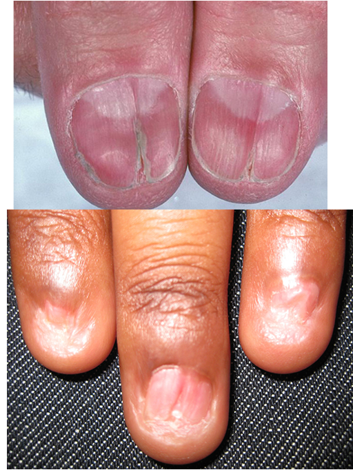 <p>varies from minor dystrophy to total nail loss; nail plate thinning and fissuring; longitudinal ridging- trachyonchyia; rapidly progressive</p><p>tx w/ intralesional or system corticosteroids</p>