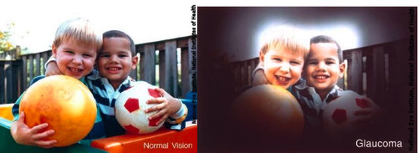 <p>damage to the optic nerve because of the pressure created by a buildup of fluid in the eye</p>