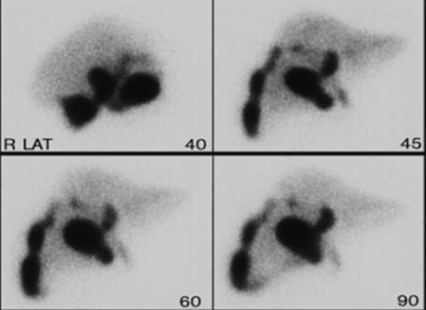 <p>What type of ROM testing is used to pinpoint adhesions?</p>