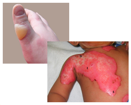 <p>Scalds</p><p><em>Causes superficial to superficial thickness burns</em></p>