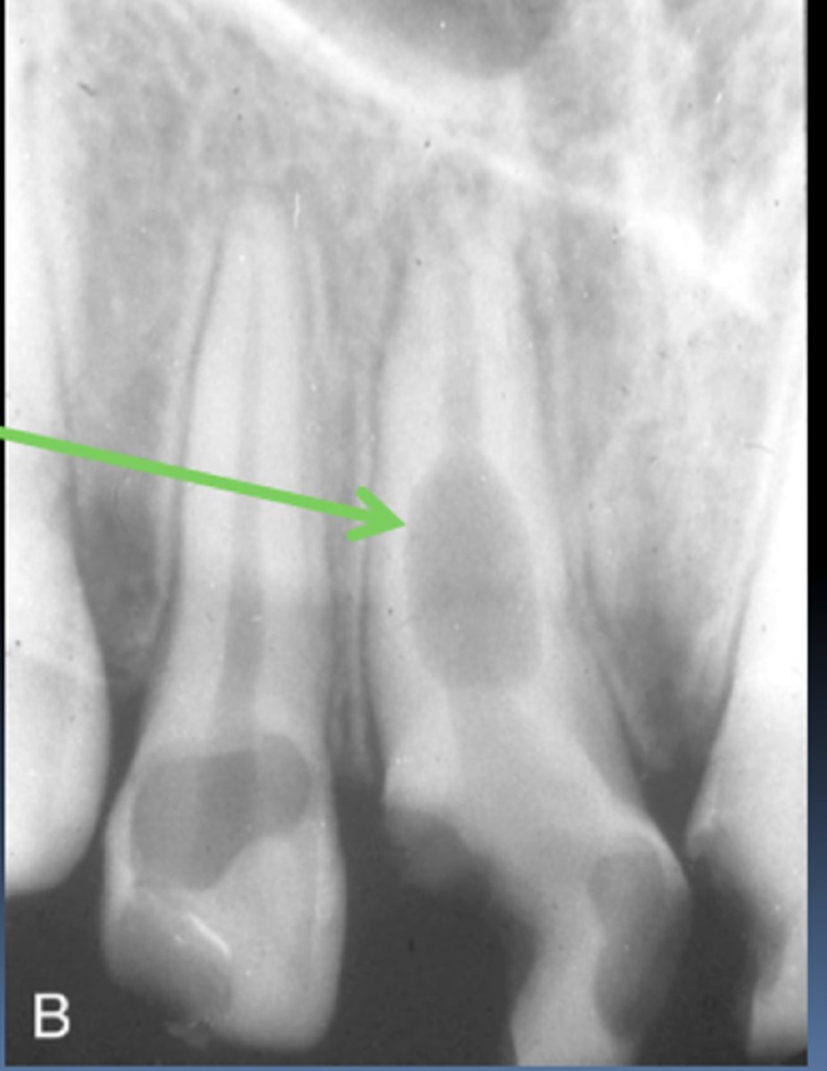 <p>-Etiology-Possible pulp injury, sometimes unknown.</p><p>-Pulp may show through enamel-tooth may appear PINK</p><p>-Enlarged pulpal chamber</p><p>-Possible endodontic therapy</p>