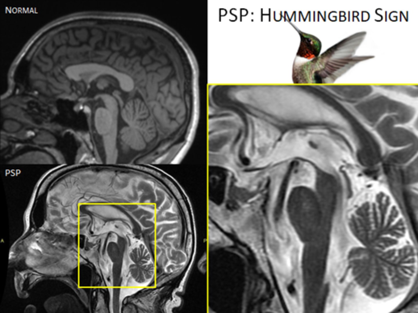<p>Define Condition:</p><p>*Mistaken as PD*</p><p>-Hx: Usually &gt; 60 y/o; Gradual onset</p><p>-Sx: Gait instability/Falls, Disturbance of speech articulation and swallowing, Impairment of eye movements (issues seeing)</p><p>-PE: Parkinsonism w/o tremor, Rigidity in EXTENSION Increased AXIAL muscle tone, Unstable gait/falls, dysarthric speech, dysphagia, Impaired eye movements (Downward vertical, conjugate ophthalmoplegia with intact VOR = “supranuclear lesions”), Intellect preserved until very late</p><p>-Dx: Brain MRI (r/o other disorders but may show classic midbrain atrophy, "hummingbird sign")</p><p>-Tx: Supportive Tx --&gt; Full Care</p>
