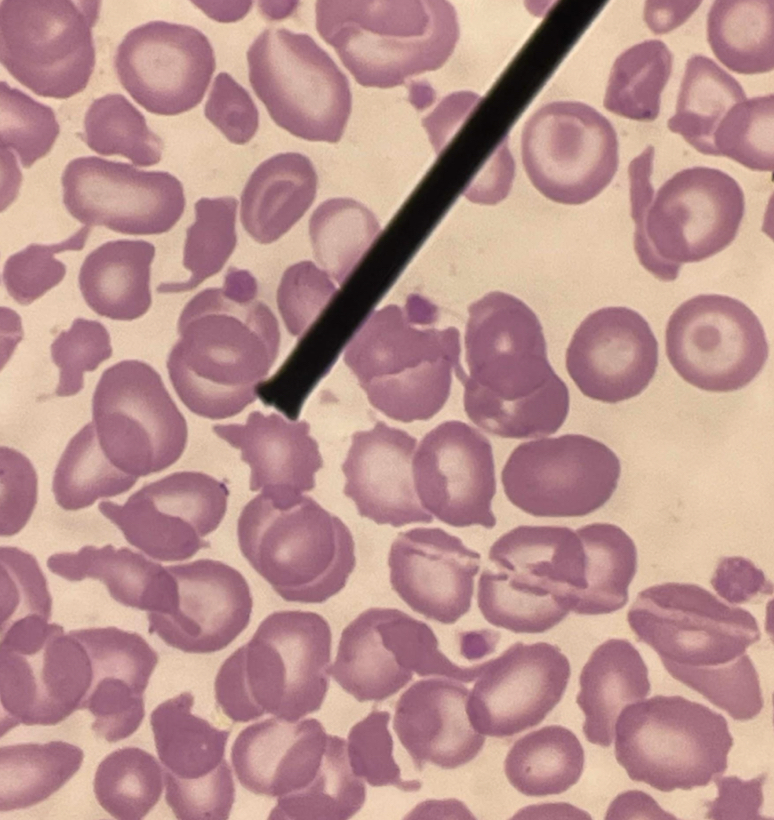 <p>A. Identify the pointed cell</p><p>B. Describe the striking feature</p><p>C. Associated with what pathological findings?</p><p>D. Other associated conditions</p>