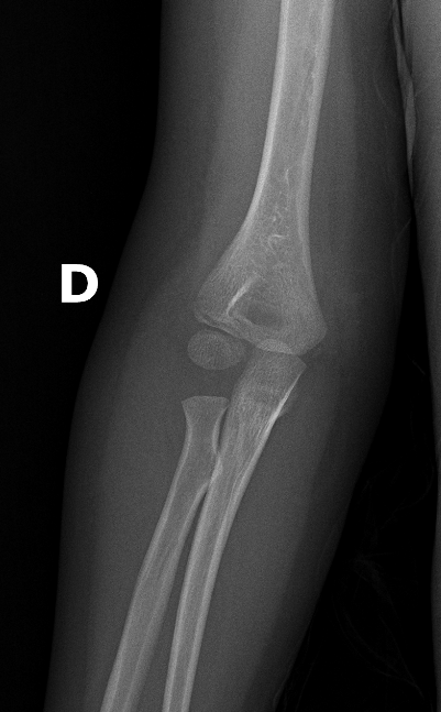 <p>Describe the abnormality demonstrated.</p>