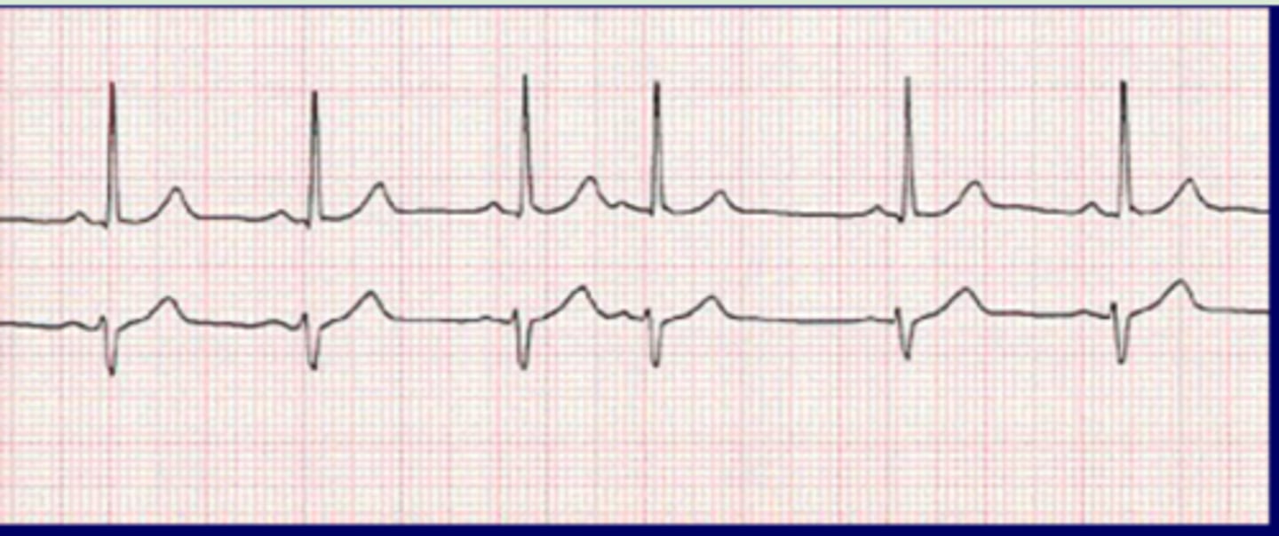 <p>Originate: ectopic atrial focus fires impulse within SR</p><p>QRS complex: narrow</p><p>P wave: different</p><p>Heart rate: 60-100 bpm until PAC</p><p>R-R intervals: regular until premature beat causes interval to come earlier than expected</p><p>Pause after premature beat</p>