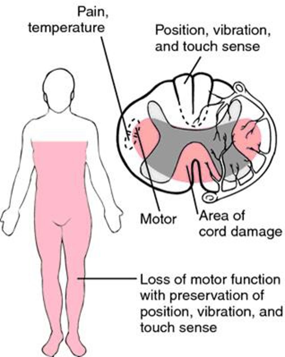 <p>What: due to hyperflexion injury of C-spine</p><p>(The head goes anterior to flex C-spine)</p><p>Preservation of proprioception, vibratory and discriminatory sense</p><p>Results:</p><p>-Loss of motor function (anterior corticospinal tract)</p><p>-Loss of pain and temp (spinothalamic tract ant/lateral)</p>