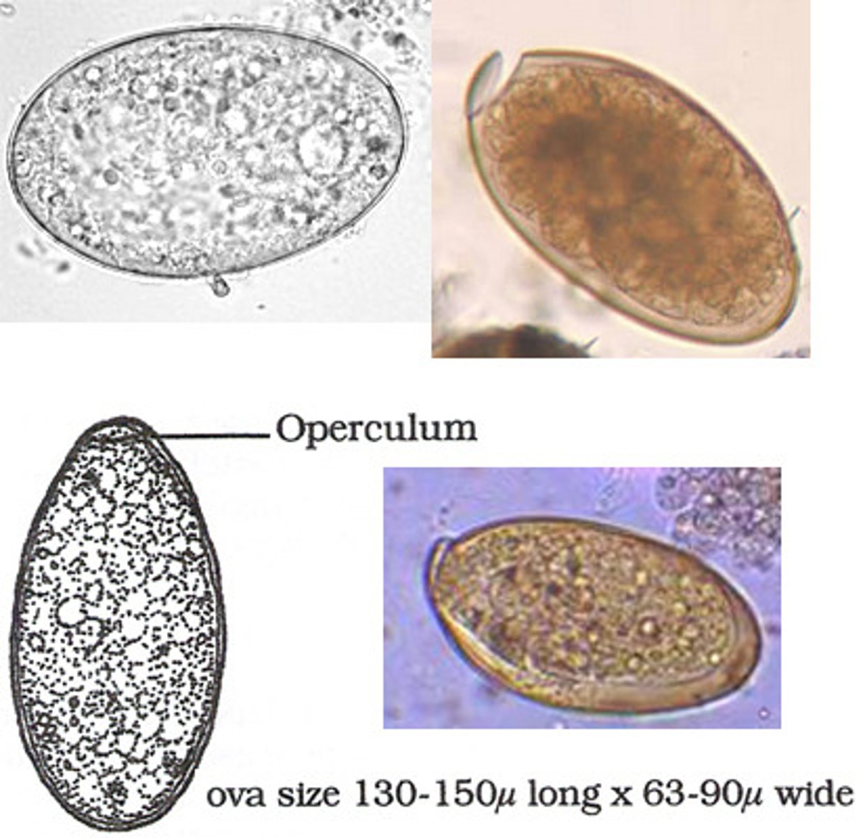 <p>Fascioliasis</p><p>Helminth (platyhelminth, flatworm) - fluke (trematode)</p>