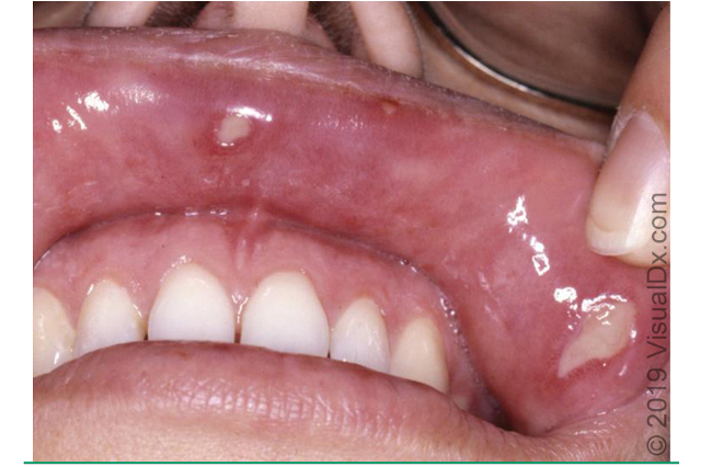 <ul><li><p>recurrent, mucocutaneous <strong>aphthous ulcers</strong></p></li><li><p><strong>genital ulcers-</strong> found ons scrotum In men and vulva in women</p></li><li><p><strong>cutaneous lesions</strong>- acneiform, papulovesicular eruptions, nodules, thrombophlebitis, palpable purpura</p></li><li><p>location: mouth, genital, ocular, GI, CNS, vascular, arthritis</p></li></ul><p></p>