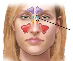 <p>Mucosa lined air spaces located above the Sphenoid Sinus and below the frontal sinus.</p>