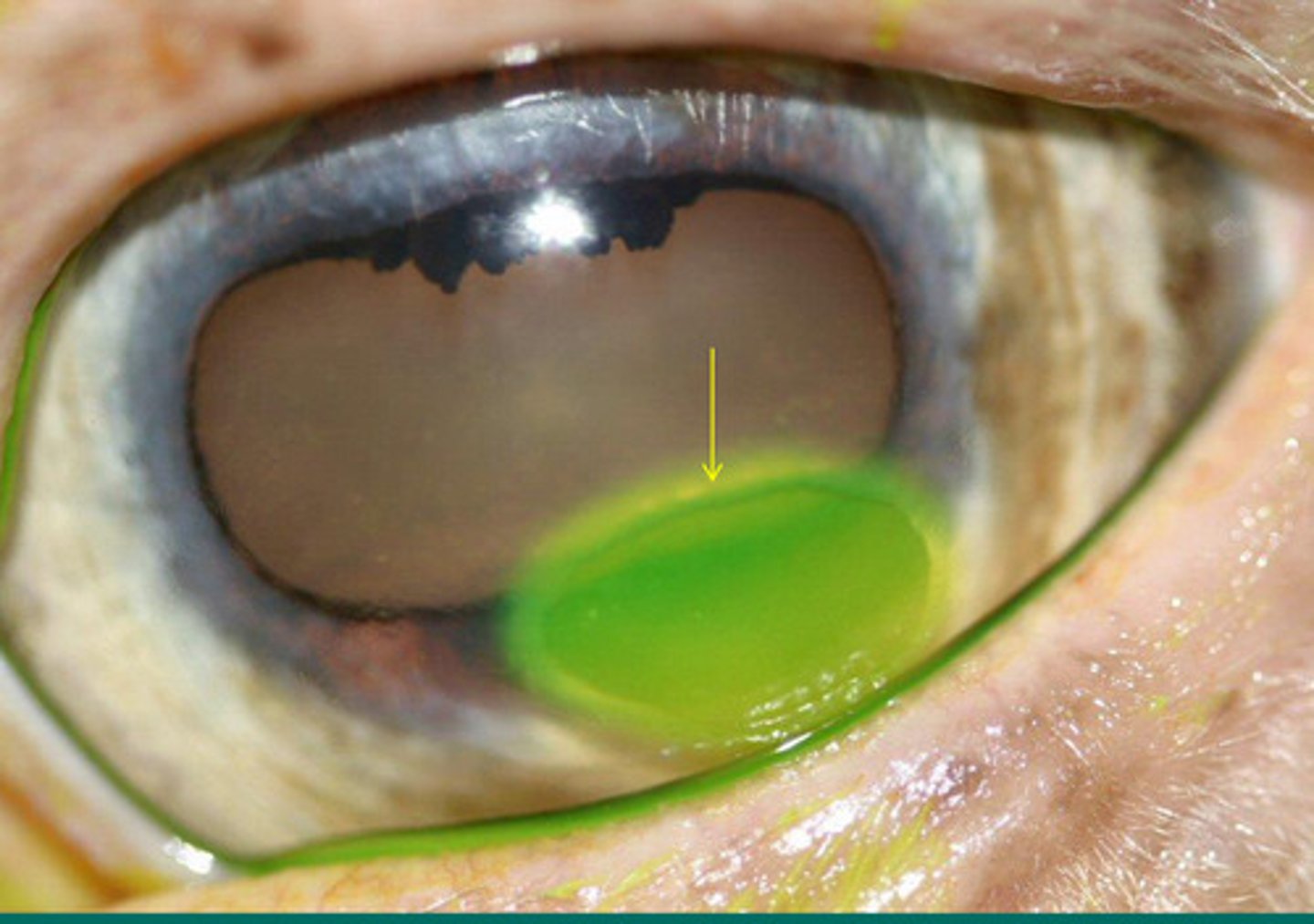 <p>The epithelium at the ulcer edge and the limbus moving across the ulcer to heal it is called corneal epithelial migration. How fast does this process move, and if there is a 5 mm diameter ulcer, this takes about how long to heal if it is a more superficial injury?</p>