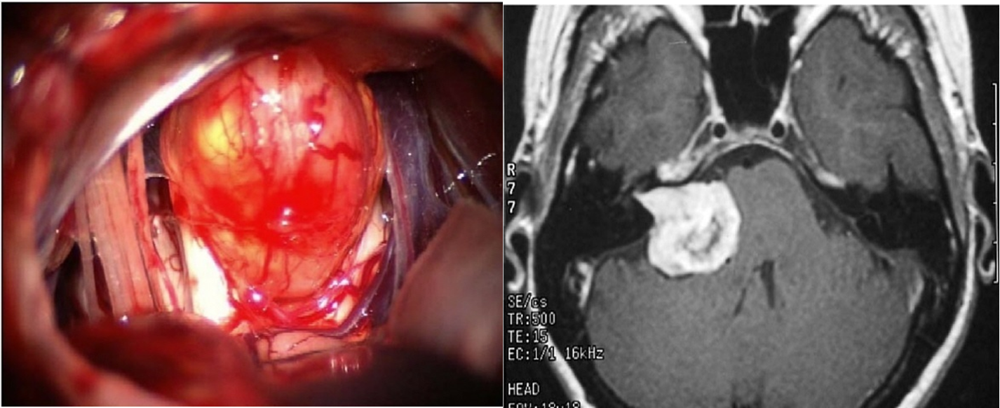 <p>noncancerous slow growing tumor on branch of CN VIII; asymmetric or unilateral hearing loss, tinnitus, vague vertigo </p>