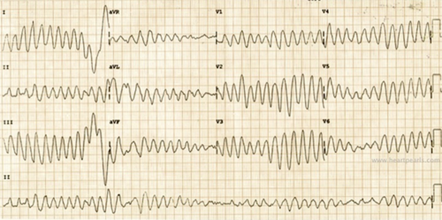 <p>- oscillatory changes in the amplitude of QRS complexes</p><p>- "twisting of the points"</p><p>- polymorphic pulseless ventricular tachycardia (pVT)</p><p>- commonly associated with medications, electrolyte imbalances, and QTc prolongation</p><p>- treatment: magnesium 1-2 g IV over 1-2 minutes</p>