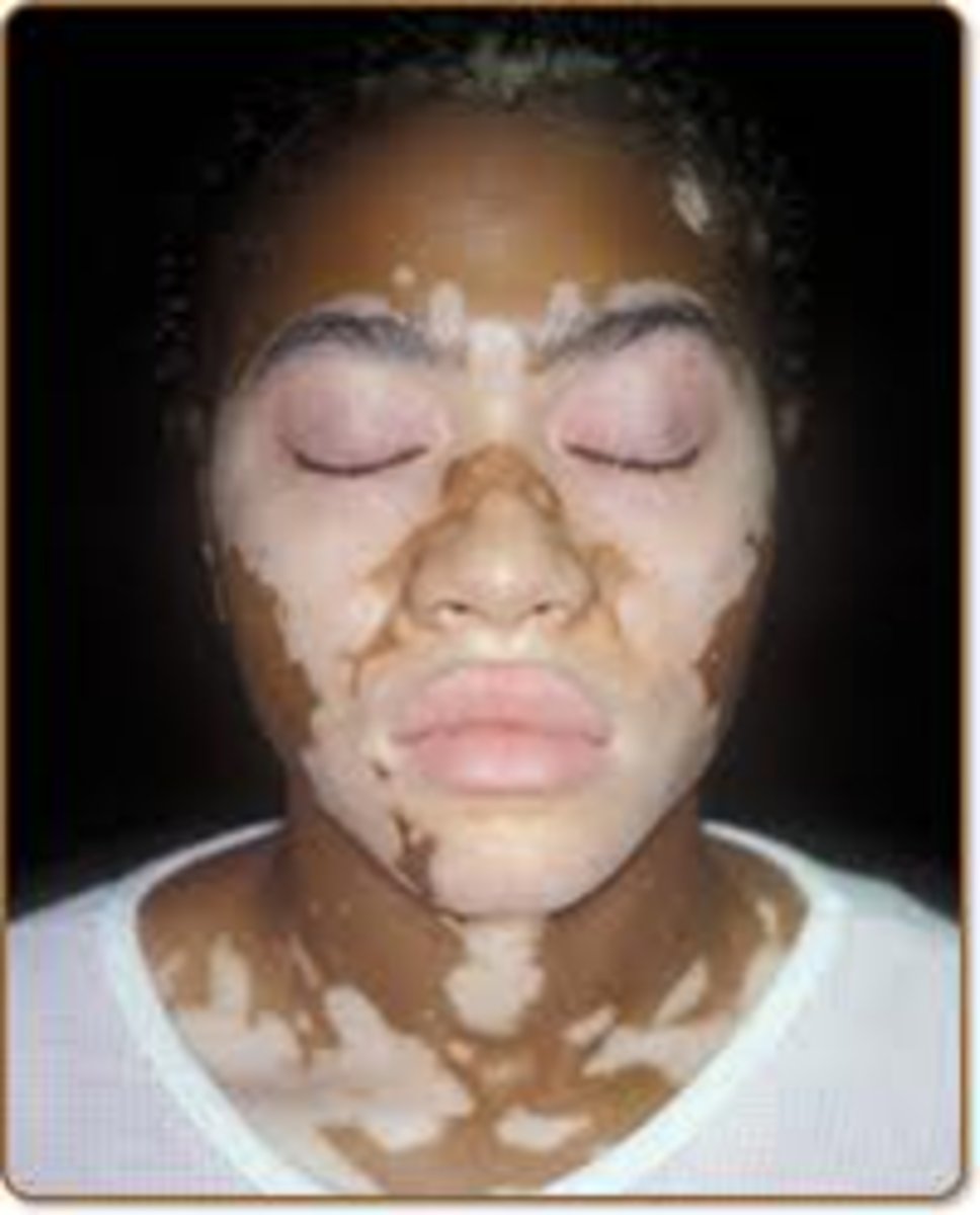 <p>Complete absence of melanocytes </p><p>Many different theories for etiology </p><p>Onset after stressful event </p><p>Totally white macules on skin and loss of pigmentation </p><p>Woods lamp </p><p>Chronic disease </p>