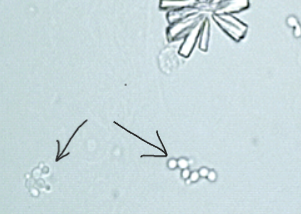 <p>What does the arrow point out in urine? What may it indicate?</p>
