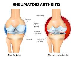 <p>Arthritis </p>