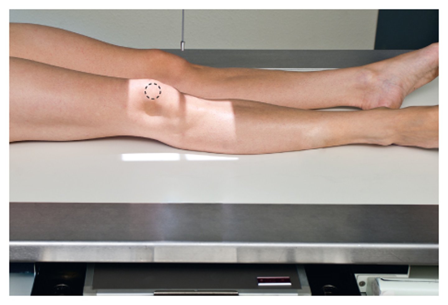 <p>rotate entire leg externally 45 degrees (interepicondylar 45 degrees to plane of IR)</p>