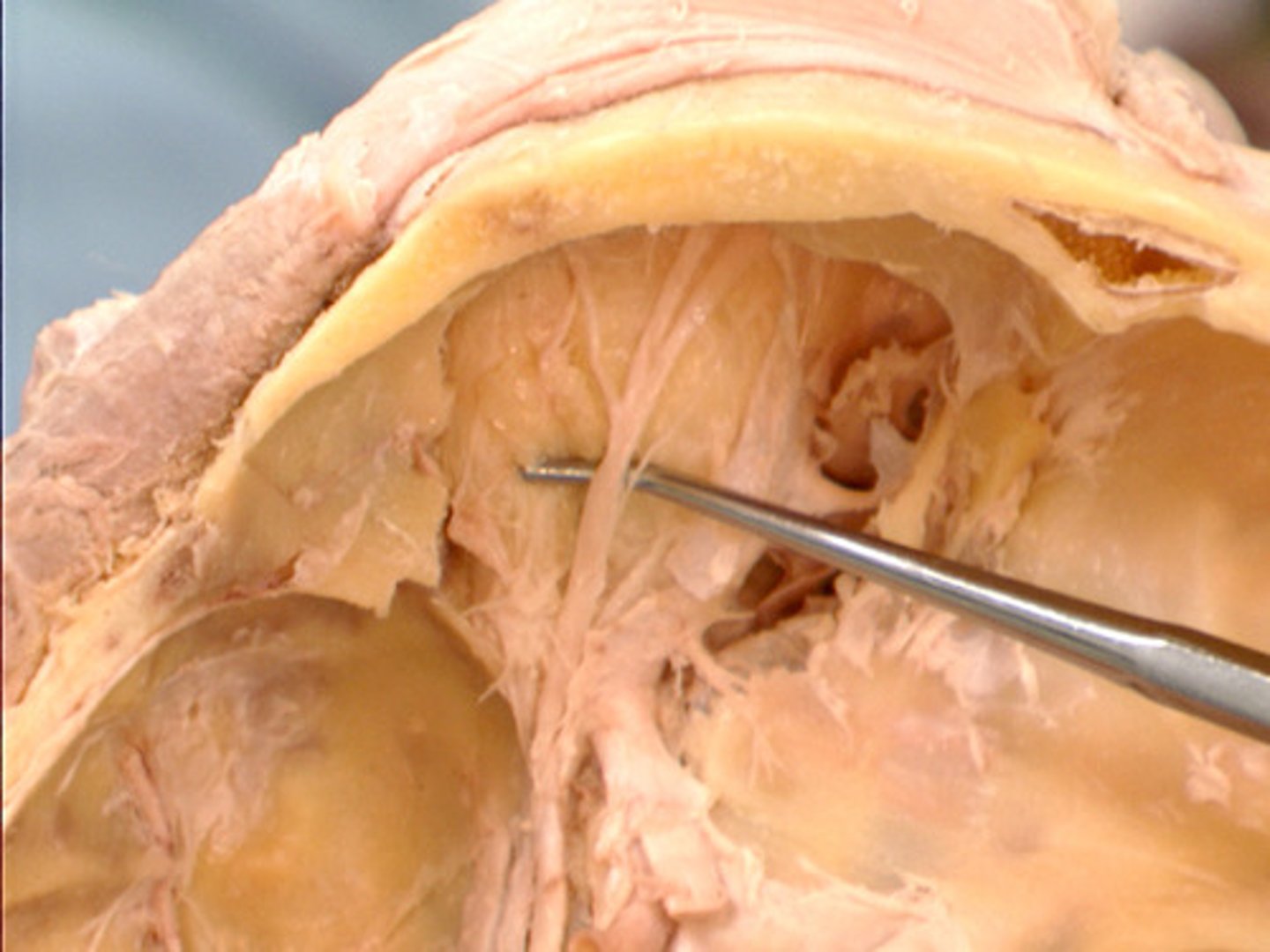 <p>passes above the levator palpebrae muscle, and divides into supratrochlear and supraorbital nerves near the outer part of the orbit</p>