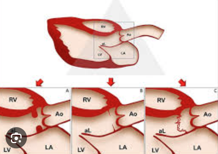 <p>fixed subvalvular obstruction <strong>(subaortic membrane or muscular subaortic stenosis)</strong> </p><p>dynamic subaortic obstruction (hypertrophic cardiomyopathy) </p><p>supravalvular stenosis</p>