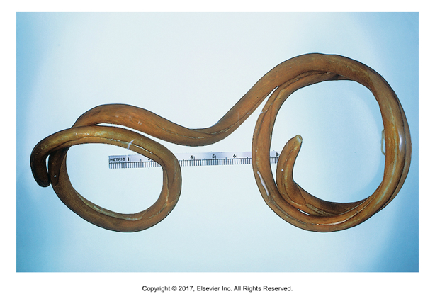 <p>Canine giant kidney worm</p><ul><li><p>Adults found in right kidney​</p></li><li><p>Found: In North America and Europe​</p></li><li><p>Cause of infection: Ingestion of larvae in annelid worm (ringed worms including earthworms and leeches) - can go through fish or frogs as paratenic hosts​</p></li><li><p>Parasite eats through the parenchyma of kidney, leaving only capsule behind​</p></li><li><p>Largest nematode. Males 30-40cm, Females can be 1m​</p></li><li><p>Barrel shaped bipolar yellow brown egg found in urine sediment​</p></li><li><p>Can "wander" into peritoneal cavity</p></li></ul><p></p>