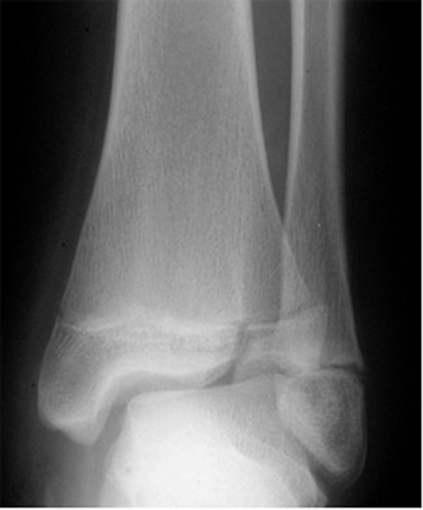 <p>what type of salter Harris fracture is this? what kind of tx is needed?</p>