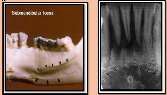 <ul><li><p>Radiolucent</p></li><li><p><strong>Fossa are mainly for the purpose of muscle attachment</strong></p></li><li><p>Ex. Submandibular fossa </p></li></ul><p></p>