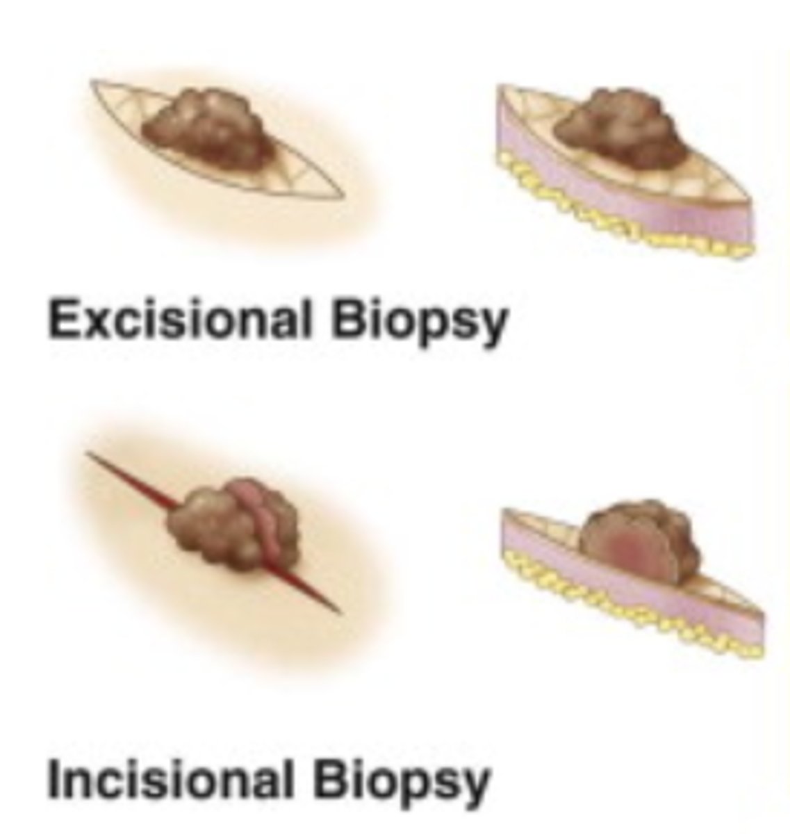 <p>________ Biopsy when Tissue is removed by "surgical cutting."</p>