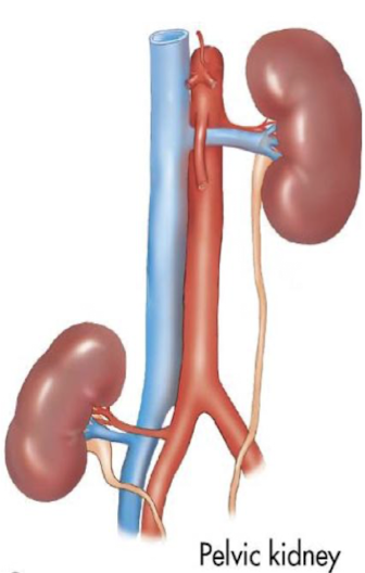 <p>aka <em>sacral kidney</em>; <mark data-color="yellow" style="background-color: yellow; color: inherit;">adjacent to pelvis</mark></p>