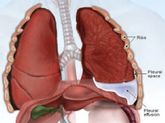 <p>fluid build up in the lungs </p>
