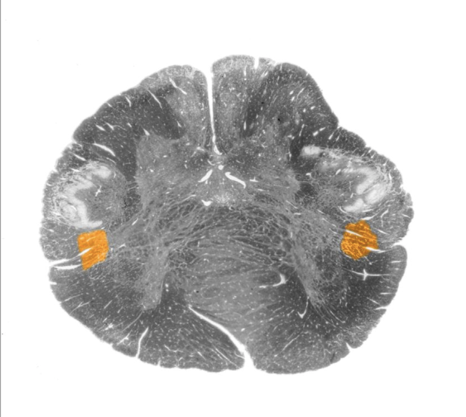 <p>Descending motor pathway by which upper motor neurons in the red nucleus project to lower motor neurons in the lateral ventral horn of the cervical spinal cord; however, this projection is vestigial and variable in humans and its functional significance is uncertain.</p>