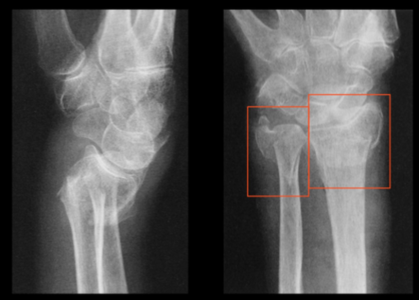<p>fracture of the distal radius with posterior displacement</p>