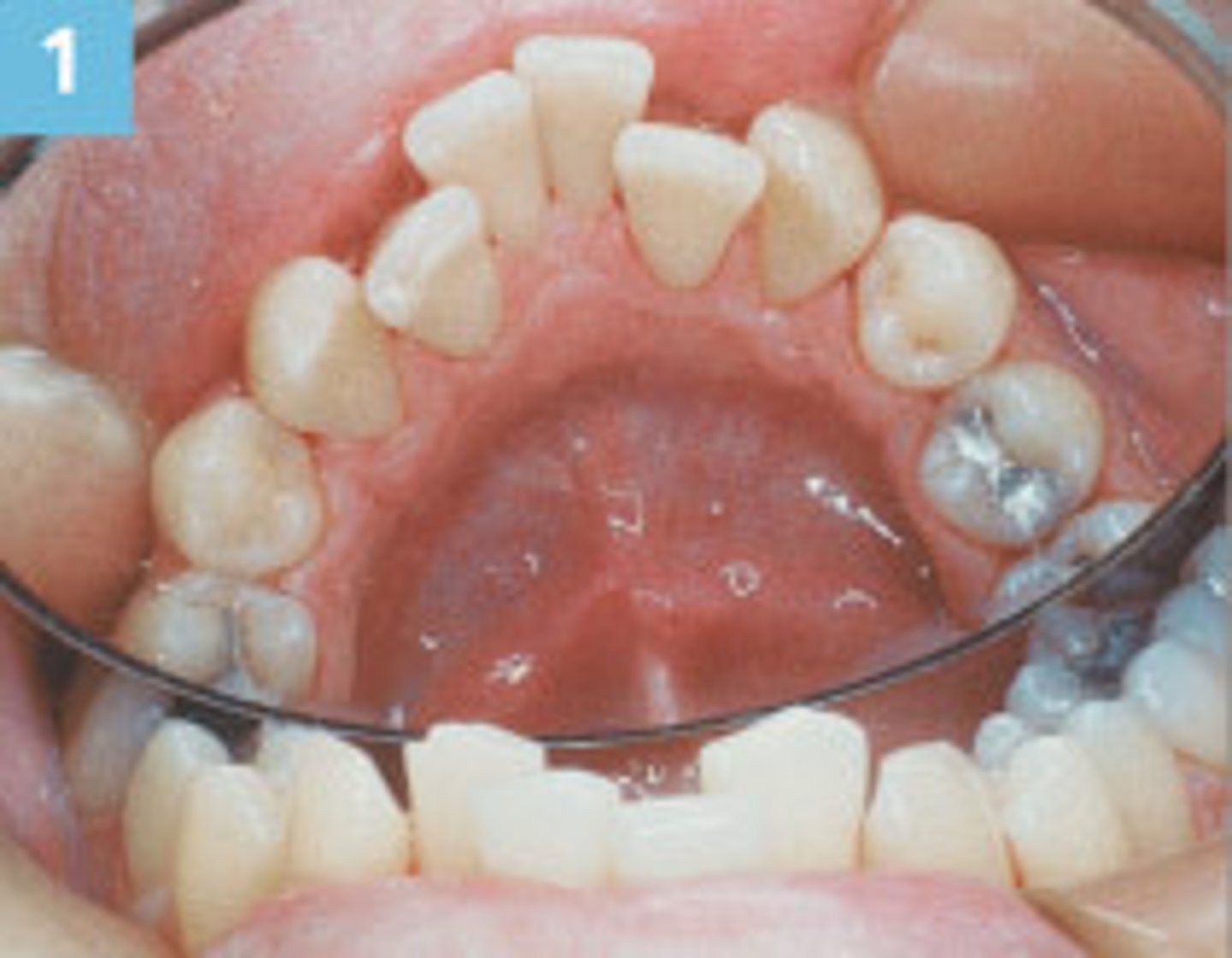 <p>sessile nodule on the gingival margin of the lingual aspect of the mandibular cuspids</p>
