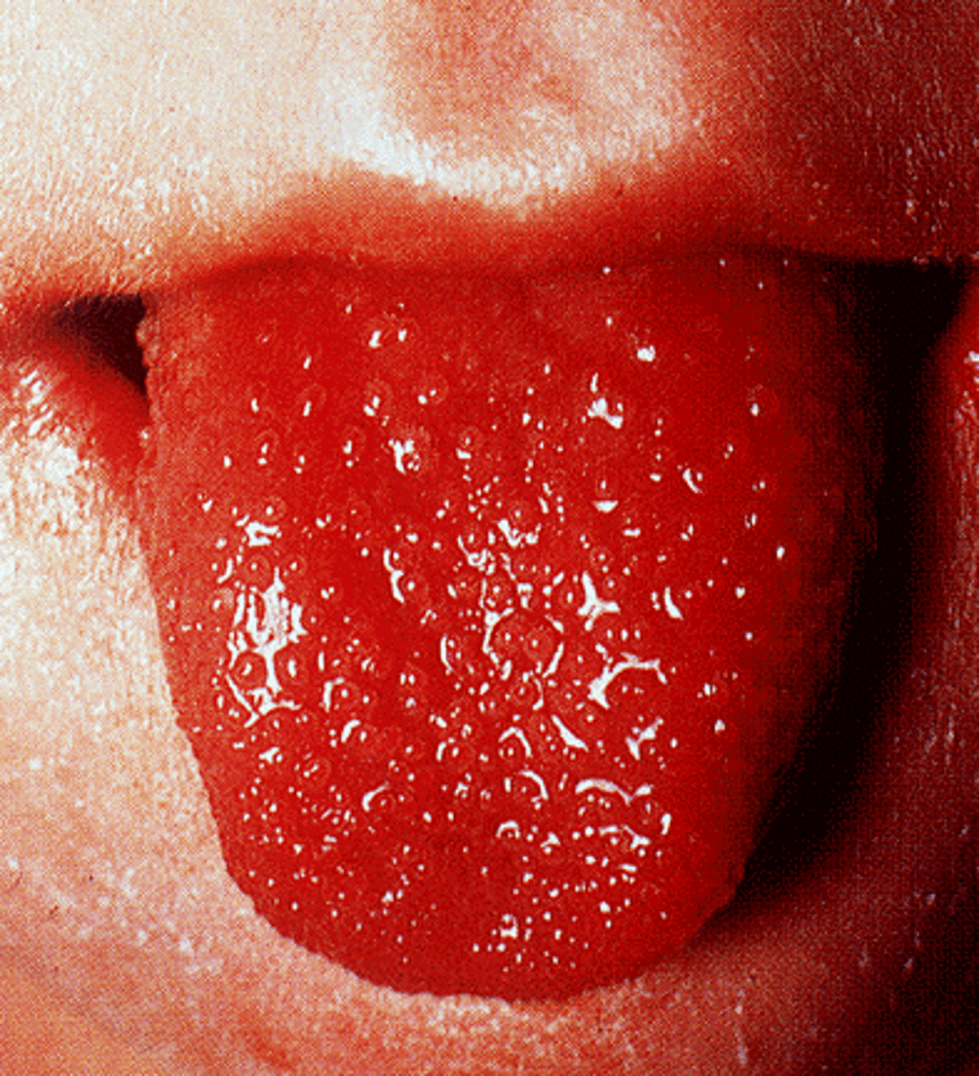 <p>-Onset of fever greater than 38.9 (102) lasting 5 days to 2 weeks, no response to antiphyretics</p><p>-RED eyes without drainage</p><p>-Bright RED, chapped lips</p><p>-Strawberry tongue with white coating or RED bumps on the posterior aspect</p><p>-RED oral mucous membranes with inflammation</p><p>-Swelling of hand and feet with RED palms and soles</p><p>- Cervical lymph nodes become enlarged.</p><p>- Children may develop abdominal pain, anorexia, and diarrhea.</p><p>- Joints may swell and redden, simulating an arthritic process.</p>