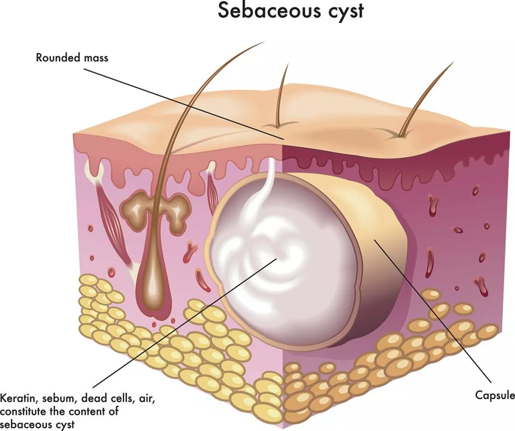 <p>E: unknown<br>adults<br>men<br>-face<br>-neck<br>-trunk</p><p>CM: benign/round/dome-shaped/encapsulated lesion+central pore/punctum</p><p>TX: none<br>surgery<br>inflammation→intralesional kenalog</p>