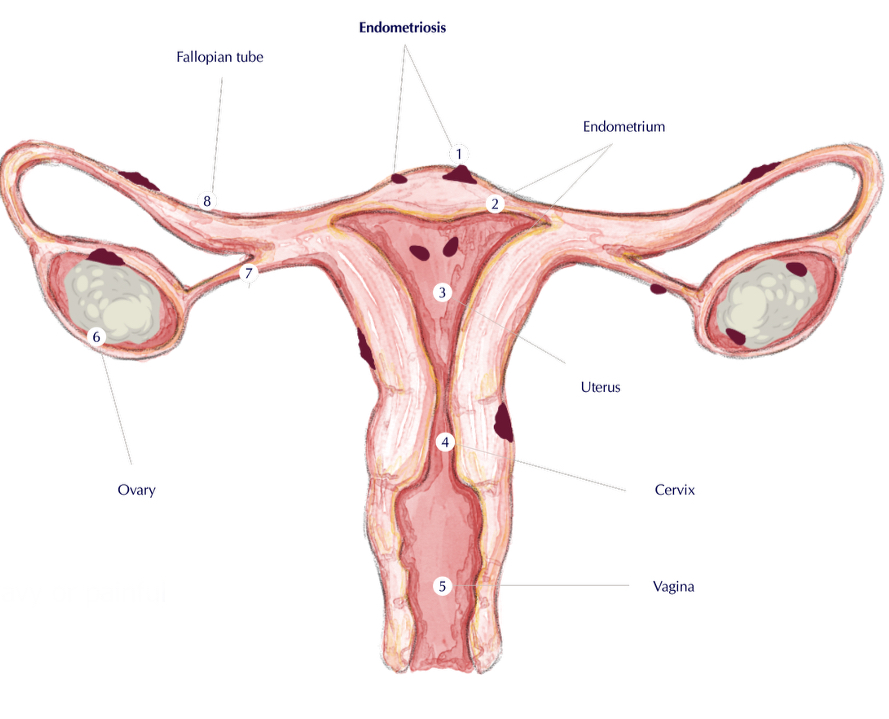 <p>The <strong>presence of endometrial tissue outside the uterine cavity</strong> </p><ul><li><p>the endometrium is the inner lining of the uterus, a muscular organ in the pelvis </p></li></ul><p>can cause <strong>pelvic pain</strong>, <strong>heavy </strong>or <strong>painful periods</strong>, and <strong>infertility </strong></p><p></p>