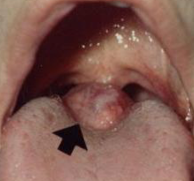<p>thyroid tissue is located on the tongue, often ONLY THYROID TISSUE (only remove if necessary), occurs in FEMALES more commonly</p>