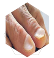 <p>What’s this called &amp; what’s it a sign of </p>