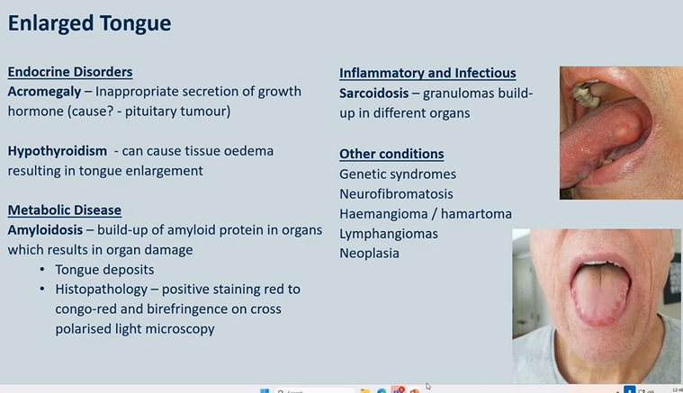 <p>Enlarged Tongue - possible causes </p>