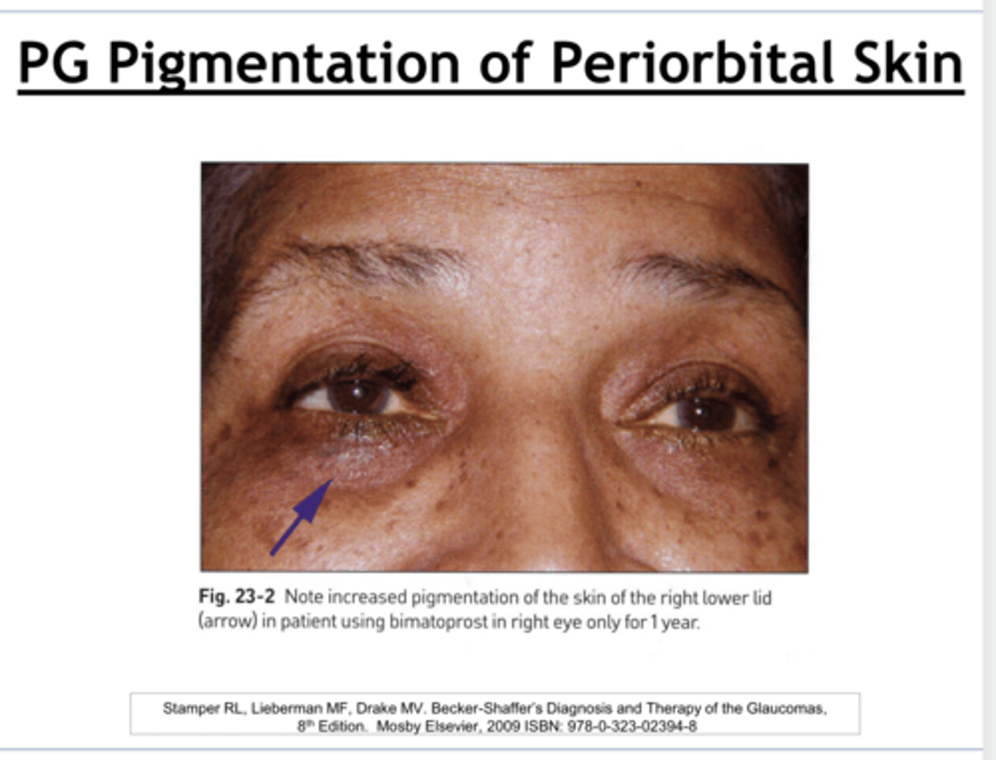 <p>Prostaglandin Pigmentation of Periorbital Skin (Pic)</p>