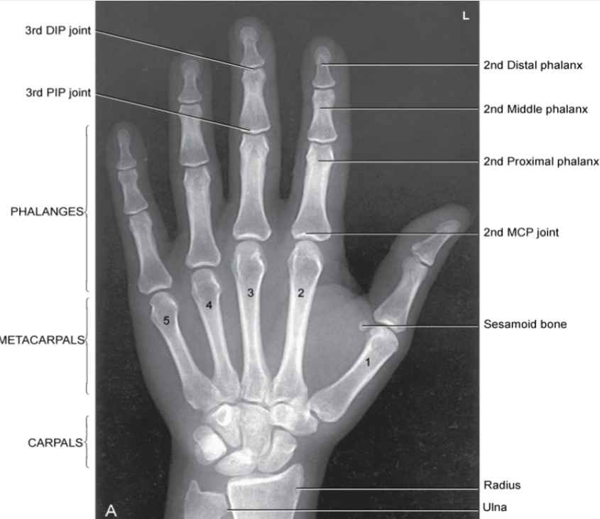 <p><span>-Proper collimation<br>-side markers laterally<br>-fingertips to distal ulna/radius<br>-No rotation: equal concavity of the metacarpal and phalangeal bodies on both sides<br>-fingernails middle<br>-equal distance between metacarpal heads<br>-open MCP and IP<br>-Trabecular detail and soft tissue</span></p>